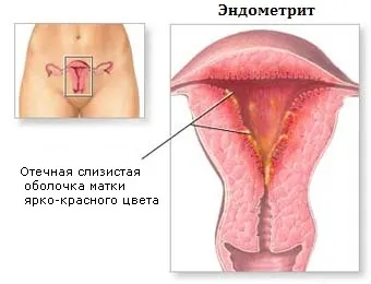 Лечение на цервикална ерозия без операция