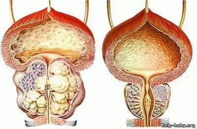 Kezelés Kínában prostatitis módszerek TCM, tibeti orvoslás, a hagyományos kínai orvoslás központja