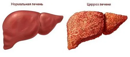 Tratarea ficat chisturile remedii populare și diete