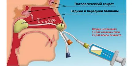 Tratamentul sinuzitei acute și acasă sinuzite maxilare și ambulatoriu