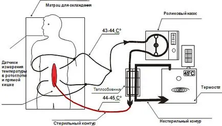 Treat peritoneális carcinomatosis hipertermikus kemoterápia