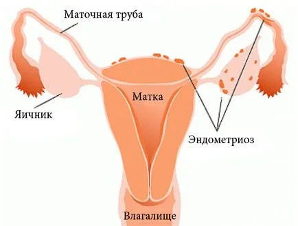 Az endometriózis Növényi kezelési módszerek és receptek