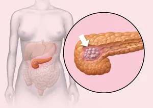 Boala lipomatoză pancreatic, de asemenea, cunoscut sub numele de degenerare grasă