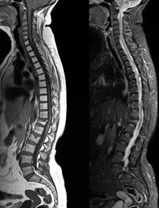 Imagistica prin rezonanta magnetica (IRM) a coloanei vertebrale în Nijni Novgorod, fbuz pomts FMBA Romania