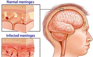 Meningitis felnőttek, olyan betegségek kezelésére,