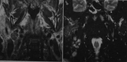 Metastazele în ganglionii limfatici 1