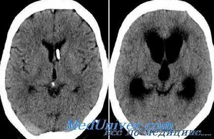 Módszerek kezelésére hydrocephalus