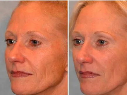 Mezoterápia arc -, hogyan kell alkalmazni a szépség injekciók