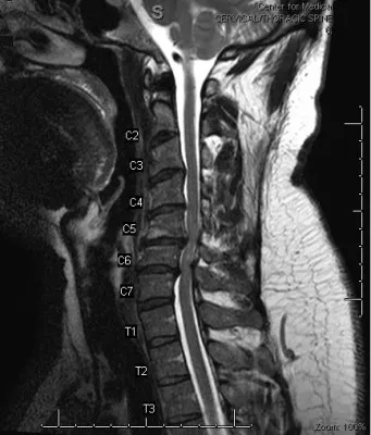 MRI на шийните прешлени и шията съдове