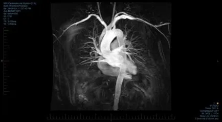 IRM a inimii și a vaselor de sânge care arată cu și fără contrast, la fel ca și