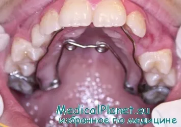 Ортодонтично лечение на периодонтални заболявания