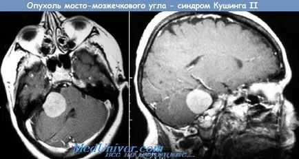 Тумори на ъгъла на cerebellopontine