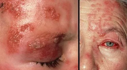 Herpes zoster emberekben a tünetek, kezelés, fotók