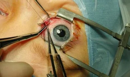изглед операция на очите на основните операции и тяхната цена