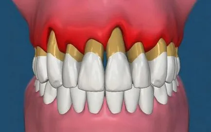 Fogszabályozó periodontális betegségek kezelésére