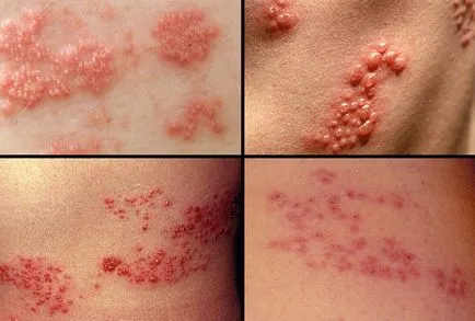 Herpes zoster emberekben a tünetek, kezelés, fotók