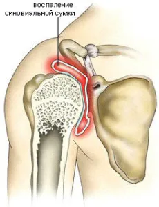 Osteochondrosis vállízület (tünetek, kezelés, képek)