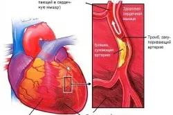 Complicațiile după clasificarea infarct miocardic de timp