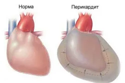 Усложнения след миокарден инфаркт класификация от време