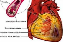 Усложнения след миокарден инфаркт класификация от време