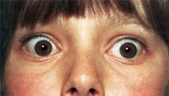 оточни exophthalmos