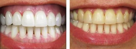 Fogfehérítés fogászat - esztétikai kozmetikai kezelések - mintegy harapás korrekció merevítések és