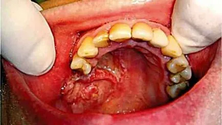 Osteomyelitis az állkapocs kezelés, gyógyszerek, népi jogorvoslati