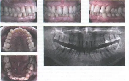 Особености на ортодонтско лечение на пациенти с пародонтални заболявания