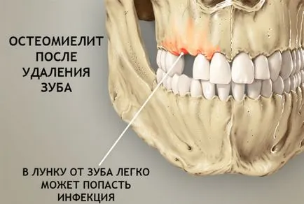 Osteomielita tratamentului maxilarului, droguri, remedii populare