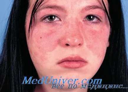 Akut kután lupus erythematosus (okkv) - diagnosztizálása, kezelése