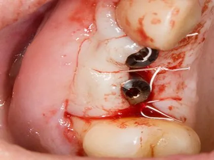 Complicațiile de implanturi dentare pentru a evita film