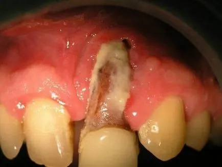 Osteomyelitis az állkapocs típusok és kezelések