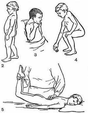 Симптомите и лечението на болестта на Pott (trachelokyphosis)