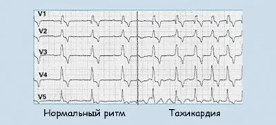 Симптомите на сърдечни аритмии, в зависимост от вида на патологията