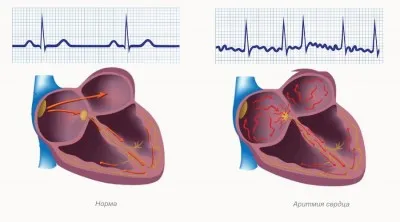 Simptomele de aritmii cardiace, in functie de tipul de patologie