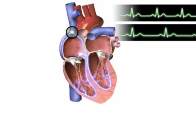 Simptomele de aritmii cardiace, in functie de tipul de patologie