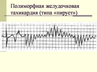 Симптомите на сърдечни аритмии, в зависимост от вида на патологията