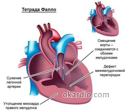 Шум на сърцето при новороденото води, видове, диагностика и лечение