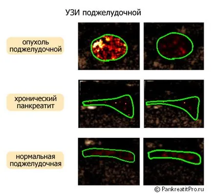 симптоми на панкреатична некроза