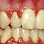 A periodontitis tünetei, kezelése, mind a fogágy