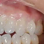 A periodontitis tünetei és kezelése