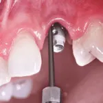 A periodontitis tünetei és kezelése