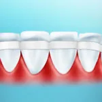 A periodontitis tünetei és kezelése