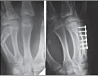 Törések a csontok a kéz és az ujjak a gyerekek - okai, tünetei, diagnózisa és kezelése