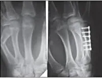 Fracturile oasele mâinii și degetelor la copii - cauze, simptome, diagnostic și tratament