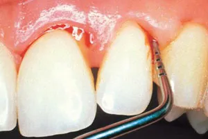Simptomele parodontita si tratament