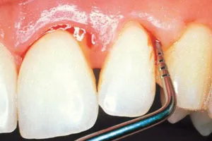 A periodontitis tünetei és kezelése