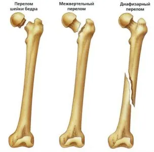 Счупване на бедрената кост на (бедрената кост, става) с изместване и без лечение, последствията, рехабилитация