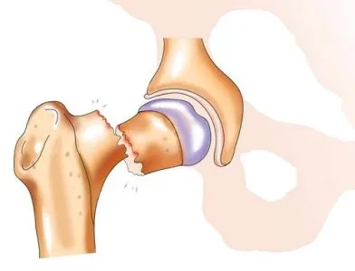 Счупване на бедрената кост на (бедрената кост, става) с изместване и без лечение, последствията, рехабилитация