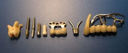 Plate implantátumok fogak és az eszköz típusa